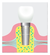 Dental implant