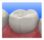 Tooth Colored Fillings Kettering