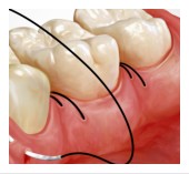 Philadelphia Gum Surgery